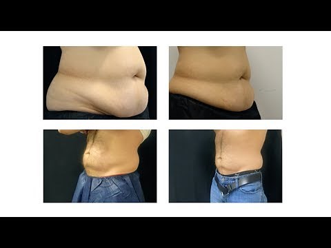 Coolsculpting Fat Freezing Treatment - Does it work?