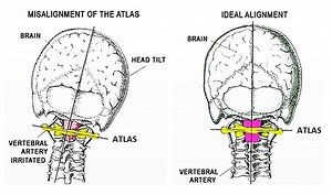 Atlas Orthogonal Chiropractor Kissimmee | Atlas Orthogonal
