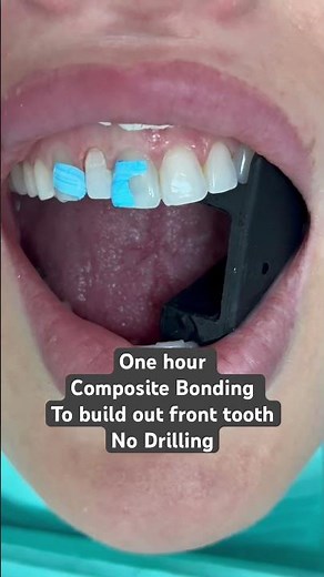 Build out front tooth ...No drilling ...Composite bonding in one hour