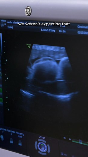 Aruba Island Rattlesnake Ultrasound! 🐍 #snakes #SeeHerGreatness #cincinnatizoo #reptile #zoobaby