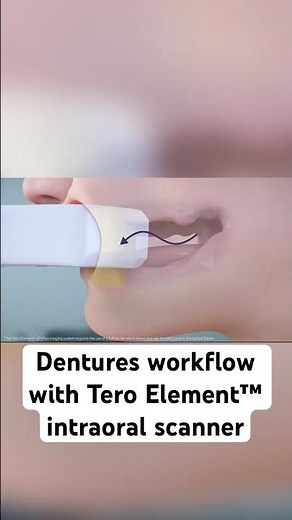 Capture bite with a putty matrix | iTero™ intraoral scanner