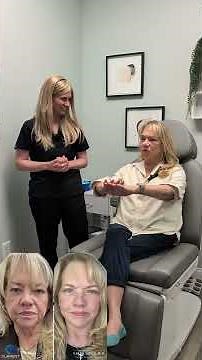 11 Days Post-Op: Feeling Great #doubleboardcertified #facialplasticsurgery