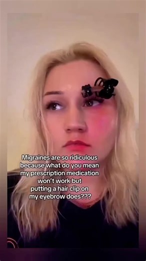 Using Hair Clips for Migraine Relief: A Unique Approach