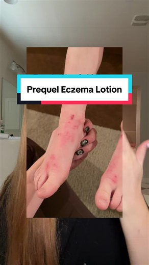 Prequel Eczema Cream: A Lifesaver for Severe Skin