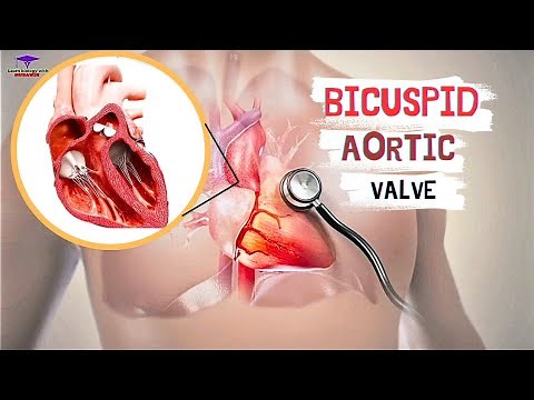 Bicuspid Aortic Valve ' #cardiology