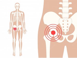 Abscesso de iliopsoas: o que é, causas e tratamento