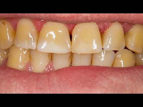 how to get rid of yellow stains between teeth