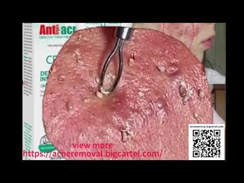 Care for and clean clogged pores