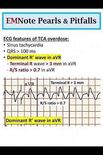 ECG Changes of TCA Overdose #doctor #medical #nursing