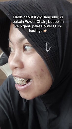 Panduan Penggunaan Power Chain Setelah Cabut Gigi