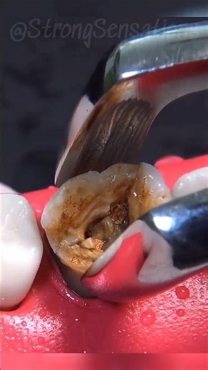 Heavy Tooth Decay Extraction #satisfying #dentist