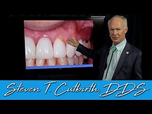 Abfraction on Tooth Colored Restorations • Video • MEDtube.net