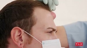 Corey turns to Dr. Lee for help removing an unsightly cyst growing on his forehead, which people at home have labeled as "devil horn.” #DrPimplePopper | Dr. Pimple Popper
