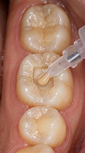 Composite Filling Explained | Treating a Small Cavity Step by Step