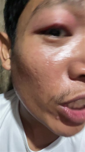 Ano ang pwede kong gawin para sa mas madaling gumaling itong kulite? #APA