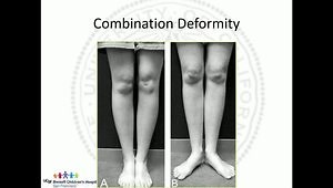 Torsional and Angular Development and Pathology of the Lower Extremities