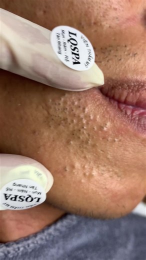 Chăm Sóc Da Mụn Tại Nhà Hiệu Quả