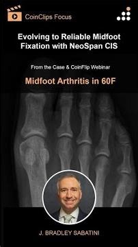 Evolving to Reliable Midfoot Fixation with NeoSpan CIS