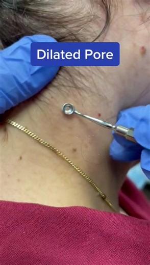 Satisfying dilated pore removal! #dilatedpore #pimpleextraction #acneextractions