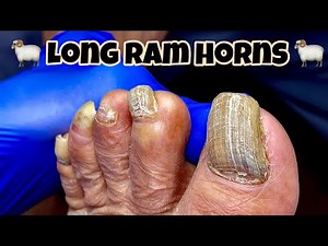 TOENAIL TRANSFORMATION - HOW TO CUT RAM HORNS 🐏