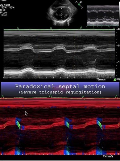 Paradoxical septal motion (severe tricuspid regurgitation)