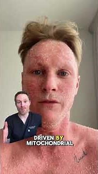 ⚠️POV: The steroids are no longer helping (topical steroid withdrawal -- TSW)