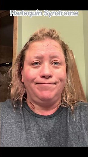 Rare Condition: Understanding Harlequin Syndrome #harlequinsyndrome