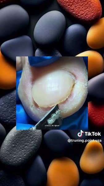 How to Safely Remove Ingrown Toenails at Home