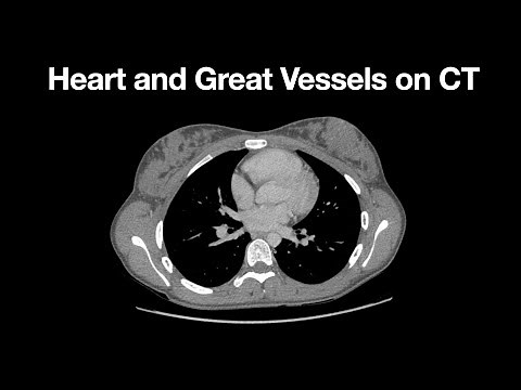 Anatomy of the Heart and Great Vessels on CT