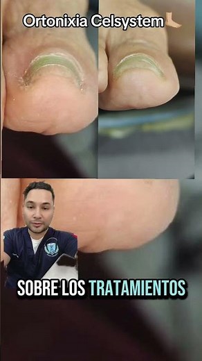 Correcting ingrown toenails / Orthonyxia in involute toenails #podiatry #podiatrist #nail