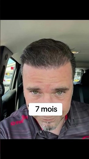 Résultat de la greffe de cheveux avec la technique FUE Sapphire | Greffe de cheveux avant et après