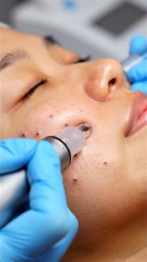 Professional Blackhead Removal with Pump Suction Machine | Relaxing ASMR 4K#021