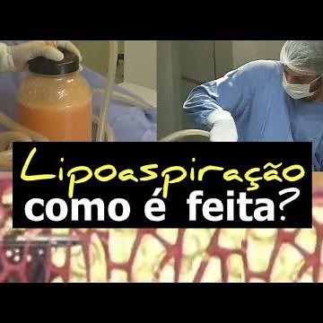 LIPOSUCTION How is it done? Before After Lipo: Dr. Walter