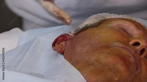 Thread lifting for a male patient is an innovative method of correcting face lifting with special ultra-thin and durable threads with multidirectional notches.