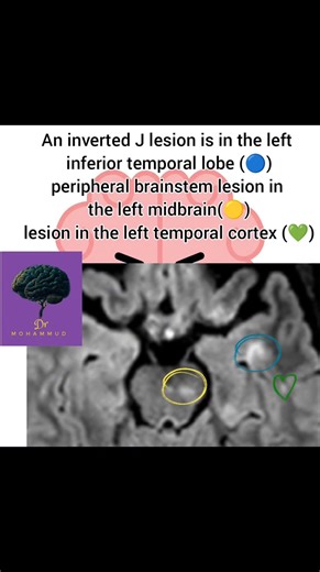 #disease #MRI #anatomy #angio #stroke #avm | CT Scan and MRI study