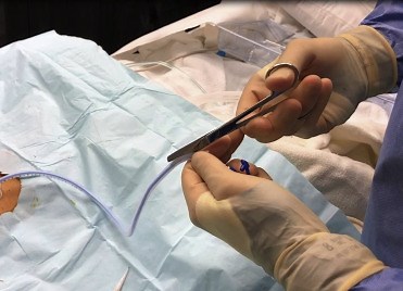 PEG J tube placement with optimization of J tube insertion