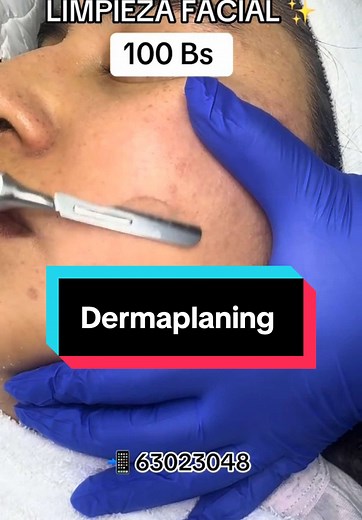 El #dermaplaning es un tratamiento estético no invasivo que exfolia la piel mediante una cuchilla de Bisturí, eliminando células muertas e impurezas, además de vello fino . Deja la piel más suave, luminosa y facilita la absorción de productos cosméticos. Es ideal para mejorar la textura y el tono de la piel, aunque no se recomienda para pieles muy sensibles o con acné activo. Agenda tu cita al 63023048 📲 #shemspa #fyp #viral_video #lapazbolivia🇧🇴 #dermaplaning #paratiii