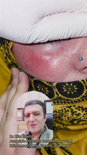 Skin Center by Dr. Bilal Shams on Instagram: "Facial redness due to application of whitening creams effectively treated with single session of Pulsed Dye Laser Vbeam perfecta Candela USA 🇺🇸 by world's renowned dermatologist Dr Syed Bilal Shams, Associate Professor of Dermatology PGMIQ & Skin Centers Quetta, Karachi and Islamabad. For appointment Quetta Clinic 0302-3855822 Karachi Clinic 0318-8855855 Islamabad Clinic 0346-9790506 #rosacea #drbilalshams #whitening #whiteningcream #sideeffects"
