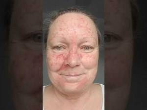 "Healing" on Day 5 after a 21-day 5% Fluorouracil treatment. January 30, 2023