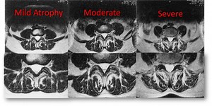 Failed Back Surgery Syndrome