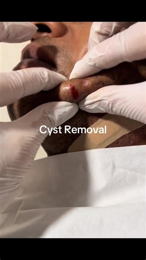 Cyst Removal #cyst #cystremoval #sac #abscess #walsallskinsanctuary