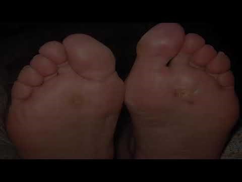 Warzen auf natürliche Weise entfernen / loswerden mit Apfelessig