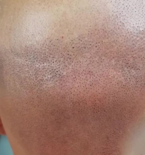 Scalp tattooing, also known as scalp micropigmentation, is a cosmetic procedure that involves the application of tiny, hair-like dots of pigment to the scalp. This can create the appearance of a fuller head of hair, camouflage bald spots or scars, or enhance the natural hairline. Some potential benefits of scalp tattooing include: 1. Improved confidence: For people with hair loss or thinning hair, scalp tattooing can help to restore the appearance of a full head of hair. This can improve self-es