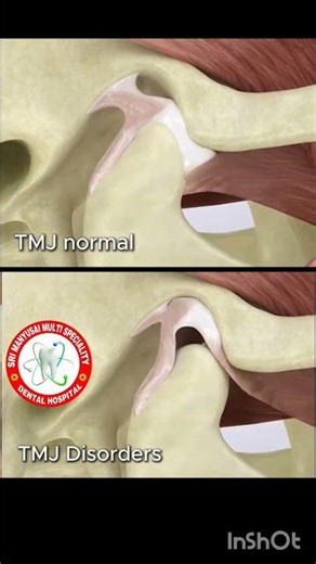 TMJ Disorder ✨✨ precautions... treatment 💫💫🎉#manyusaidental