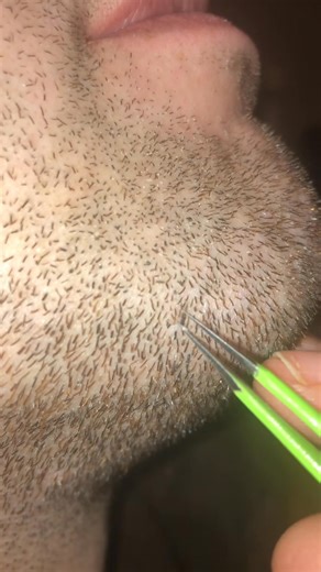 Pili multigemini | PickyNiki