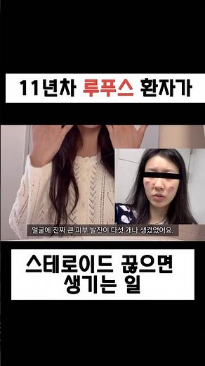 루푸스 환자가 스테로이드 끊으면 생기는 일은? #루푸스 #자가면역질환