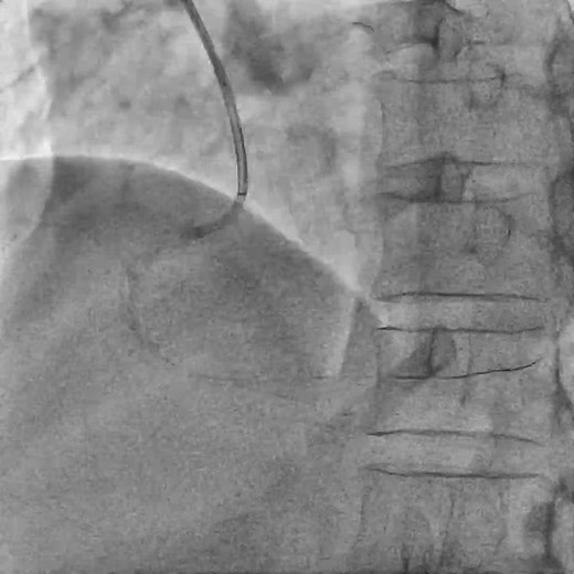 Guidezilla Extension Catheter During Primary PCI: A step-by-step lesson