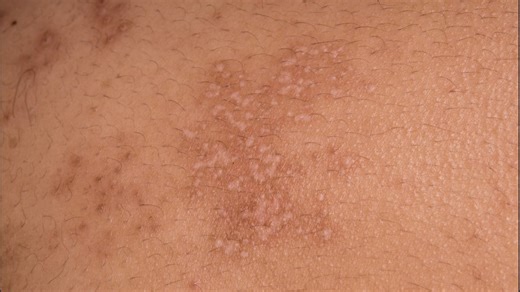 New molecule could treat virus that causes shingles, chickenpox