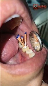 How Do Dental RCT full process with cap making #dentist