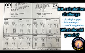 IOL Calculation Quiz: Ultra-High Myopia